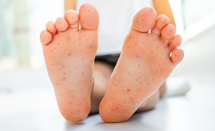 El Ayak Ağız Hastalığı